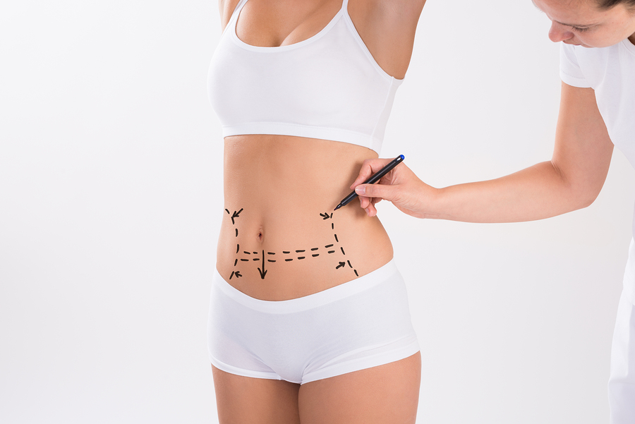 Liposuction Redlands